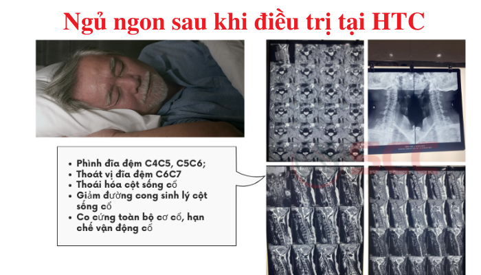 Thoát vị đĩa đệm đa tầng C4C5 C5C6 C6C7 gây mất ngủ